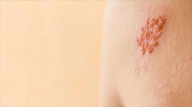 Los 7 mitos m�s comunes del herpes z�ster