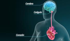 Los infartos cerebrales se pueden prevenir